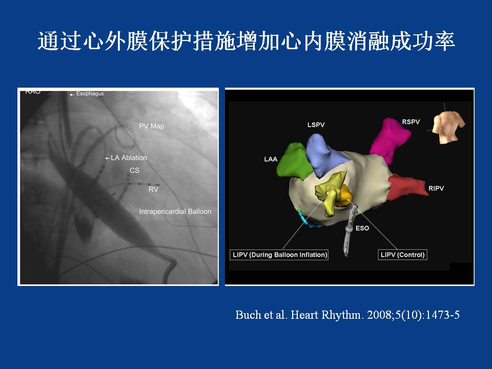 房颤的心外膜消融