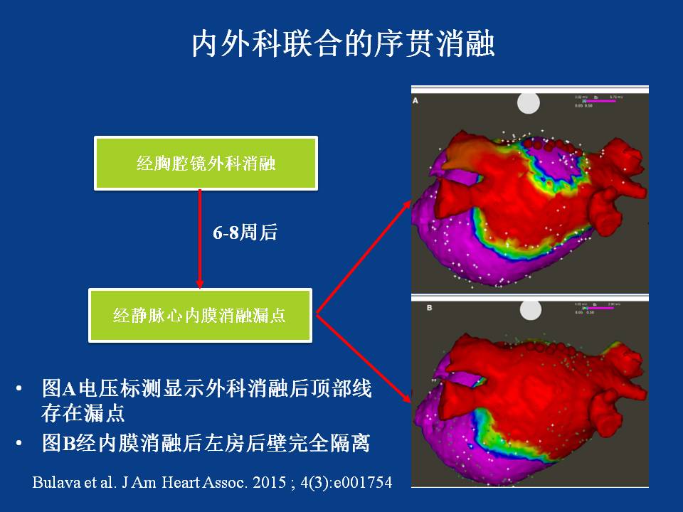 房颤的心外膜消融