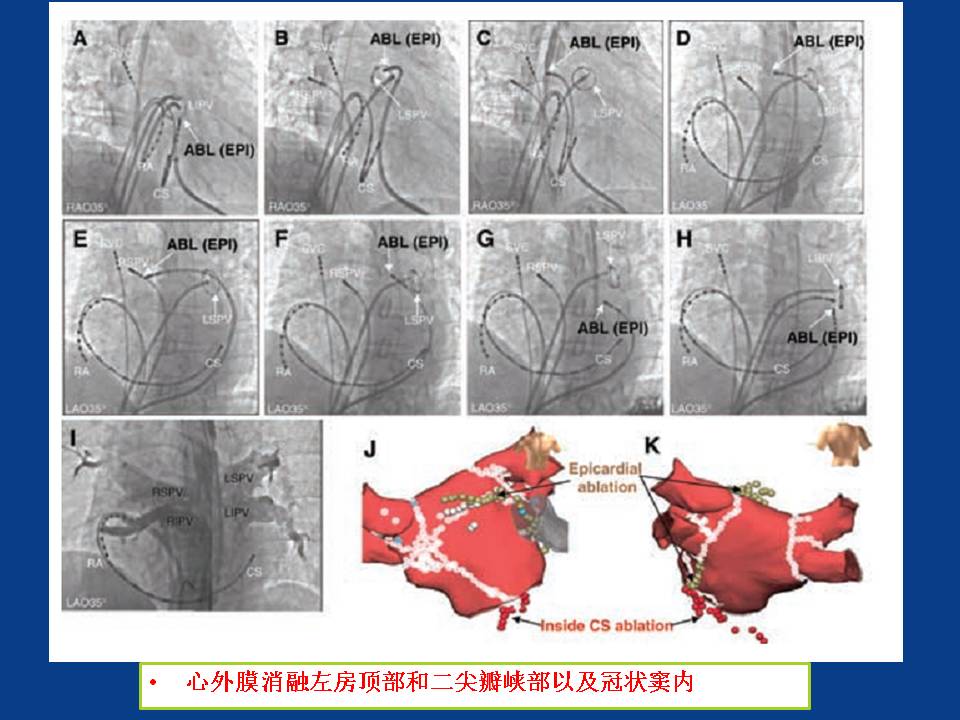房颤的心外膜消融