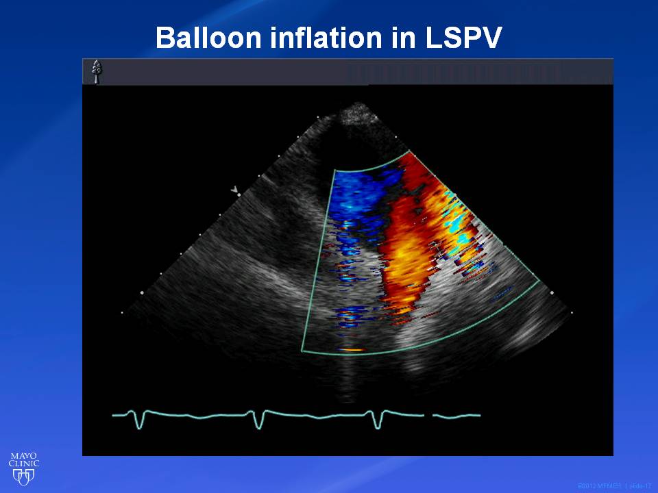 New Technology For Af Ablation From Mayo Clinic