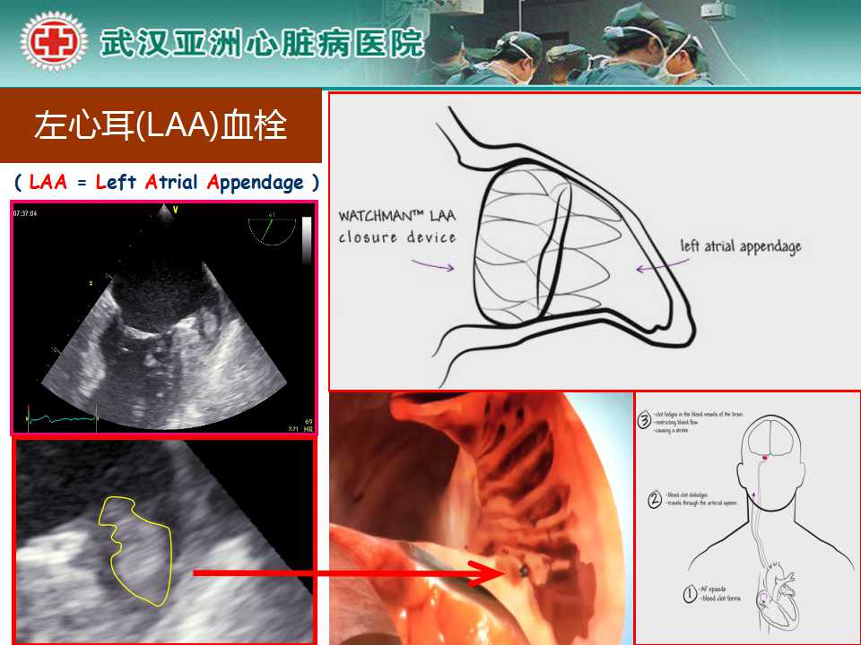 左心耳封堵治疗形态特征与封堵策略