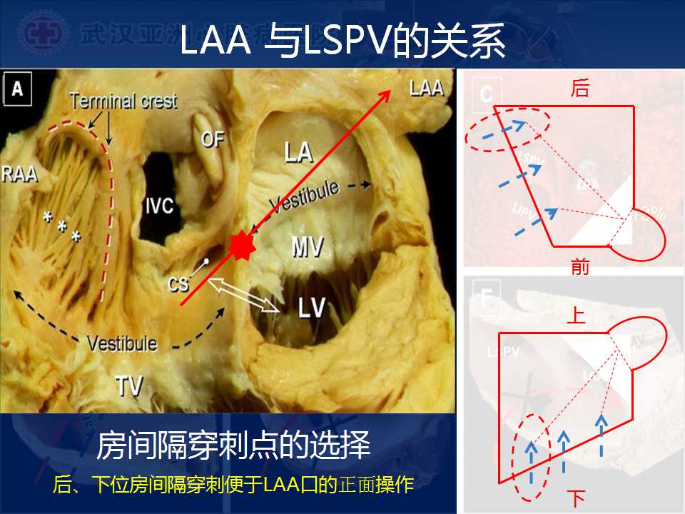 左心耳封堵治疗形态特征与封堵策略