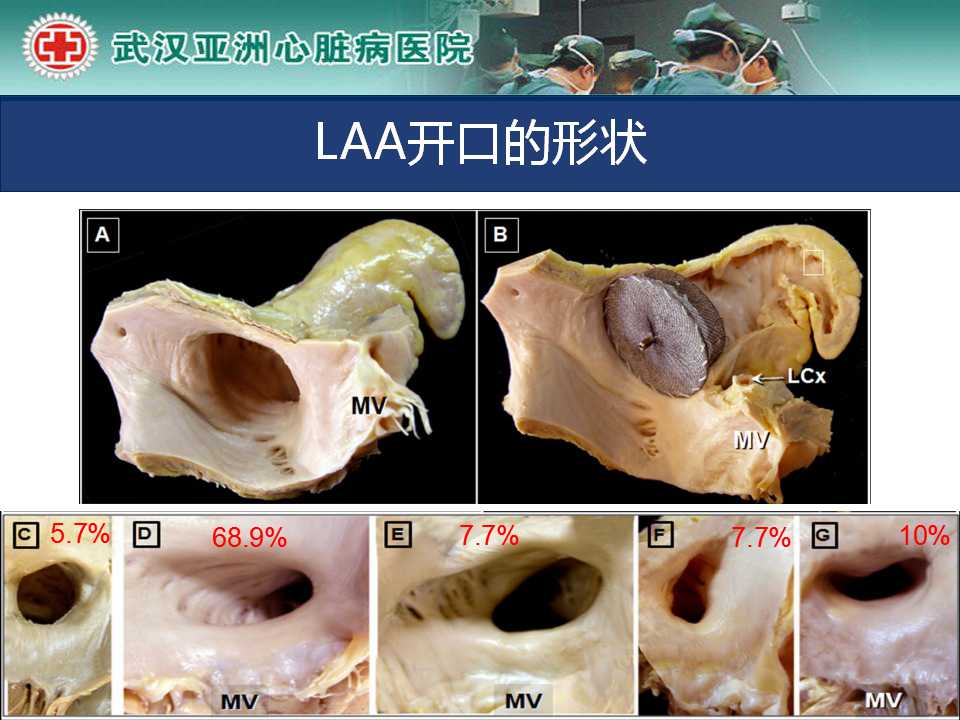 左心耳封堵治疗形态特征与封堵策略