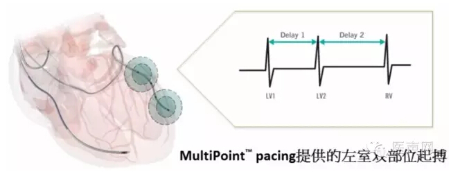香港大学深圳医院心脏远程监护管理中心成立 暨深圳首台MPP左室多位点起搏CRT-D植入