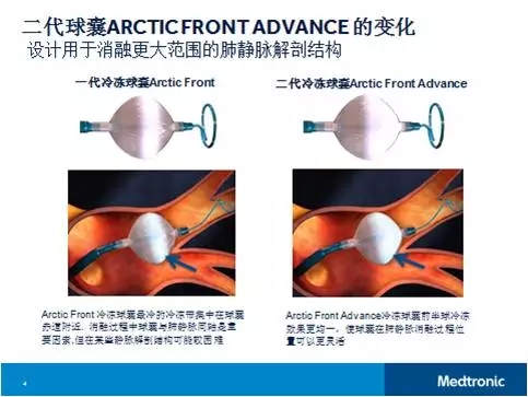 首批第二代球囊型冷冻消融导管在中国开展应用