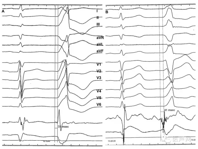 对于体表心电图胸导联移行在v3 的患者,参考avl/avr比值,有助于更好的
