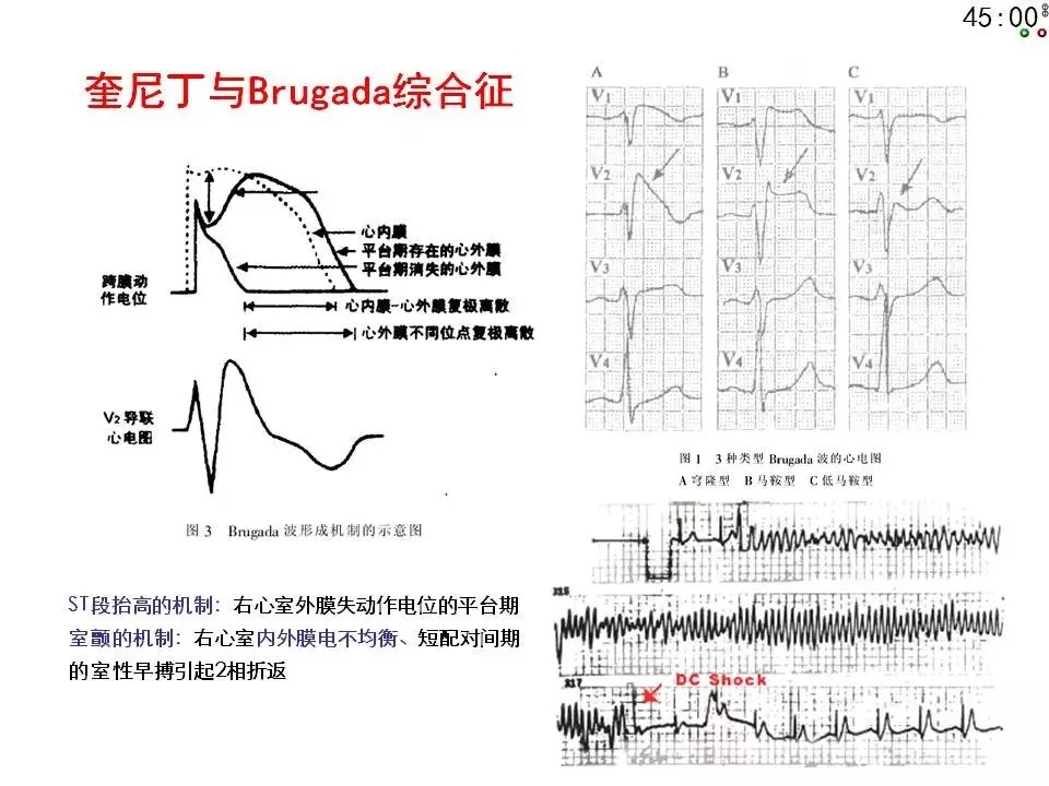 舒茂琴：抗心律失常药物临床应用——老药新用