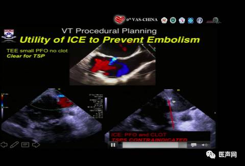 Fermin Garcia：心腔内超声（ICE）在室性心动过速射频消融中的应用价值