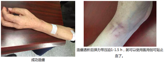 四川省人民医院 房颤伴CKD使用WATCHMAN左心耳封堵一例