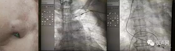 专家为救命“拆”了75岁奶奶的心脏起搏器 永久性心脏起搏器电极拔除术在湘雅常规开展
