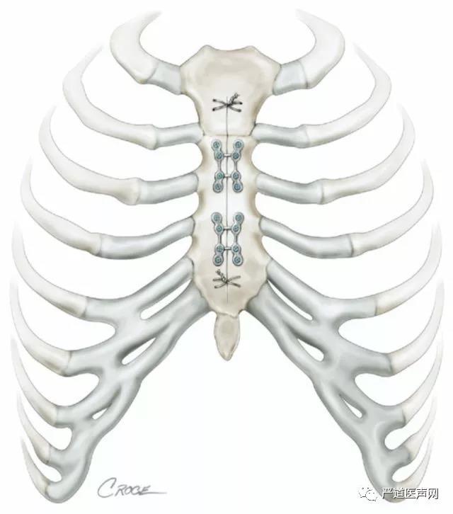 陆树洋胸骨正中劈开术后如何复位固定胸骨才是最佳的