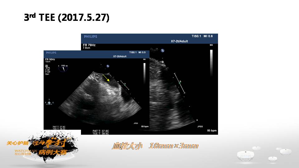 参赛病例|一例左心耳血栓患者的探讨