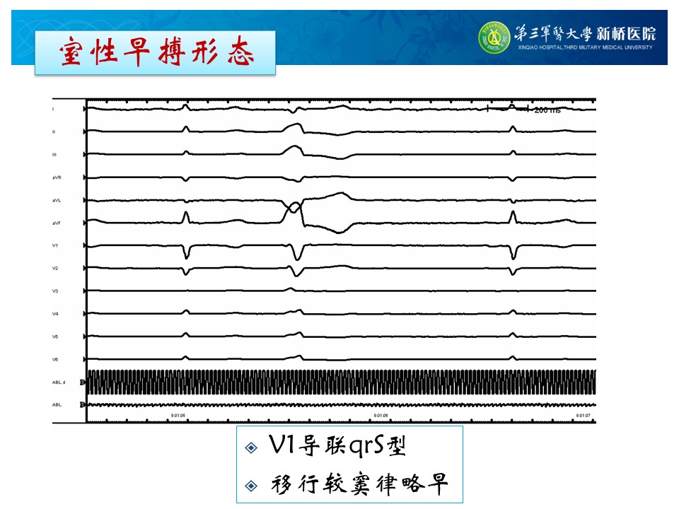 参赛病例21 | 宋元彬:特殊电位指导消融流出道室早1例