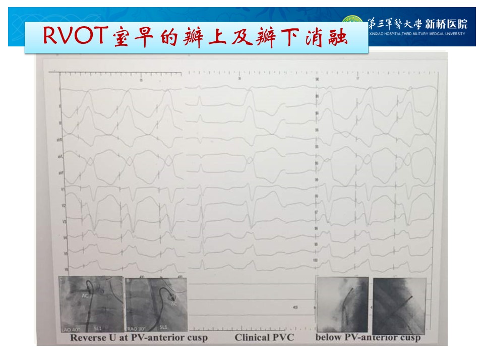 参赛病例21 | 宋元彬:特殊电位指导消融流出道室早1例