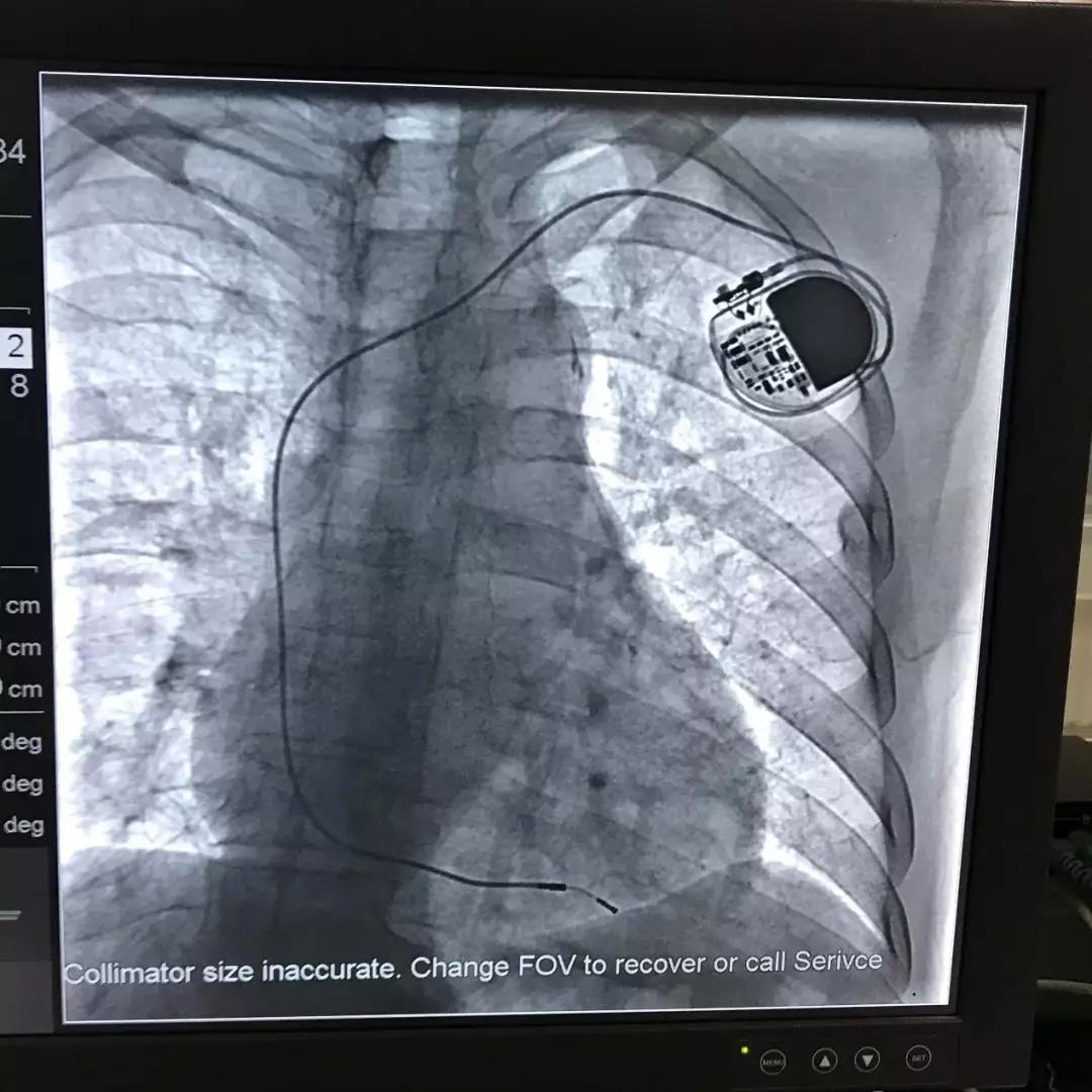 术后有保障——国产芯彤新型心脏起搏器在威海市立医院完成植入