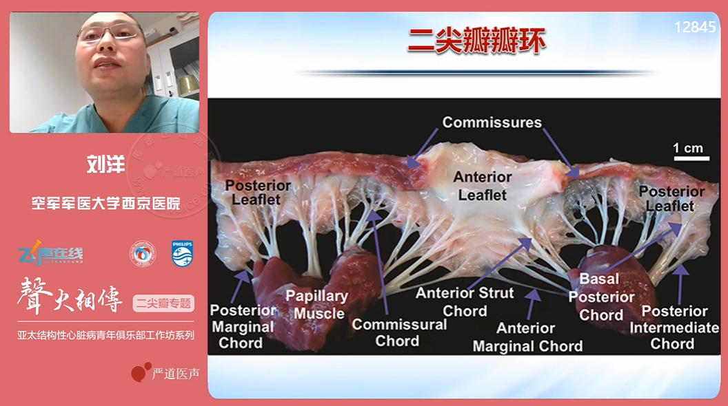 刘洋教授分享了《二尖瓣的应用解剖》,二尖瓣解剖结构相对比较复杂