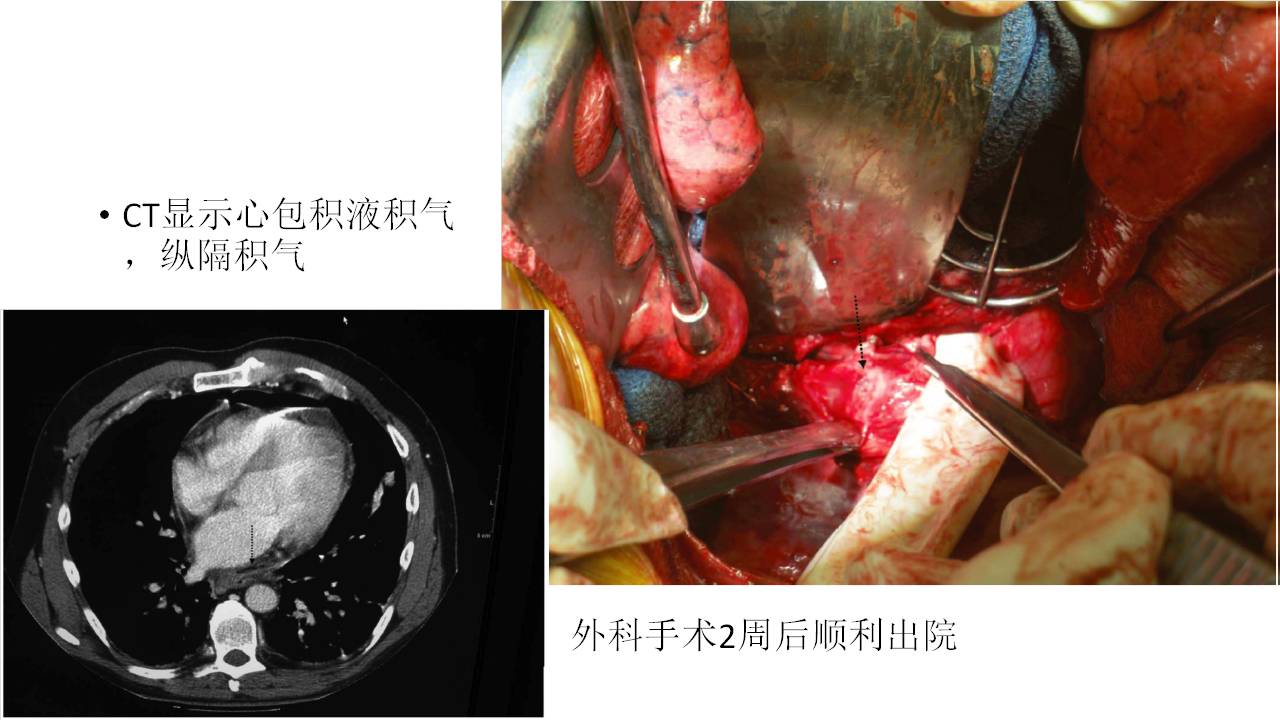 胸壁瘘管百科图片