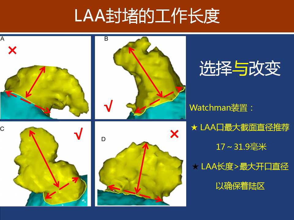 左心耳封堵适应症图片